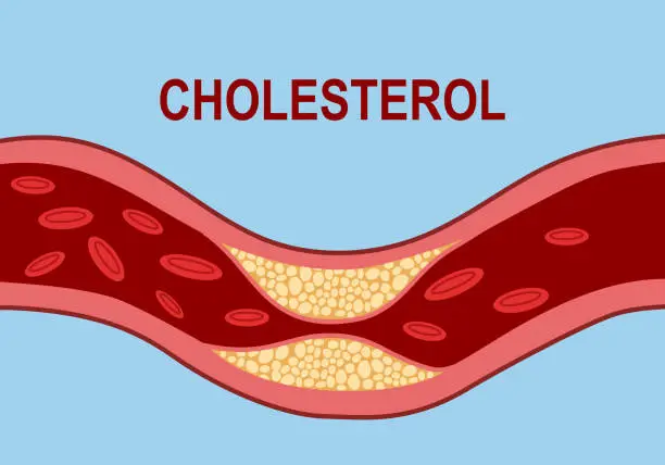 What Causes High Cholesterol? Risk Factors You Should Know 4 What Causes High Cholesterol